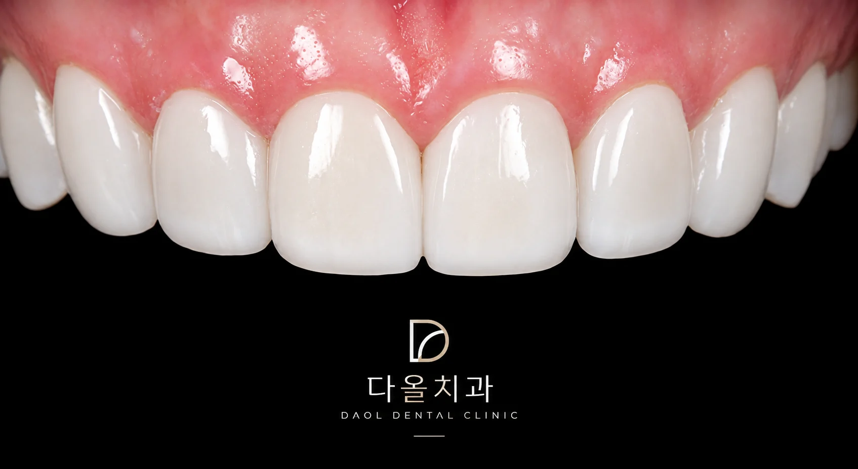 다올치과에서 치료한 앞니 라미네이트